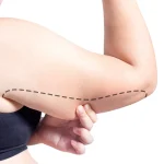 Kol Germe Ameliyatı Kimler için Uygundur?