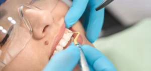 Diş Taşı Temizliği