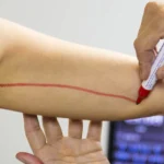 Cirugía de Liposucción de Brazo