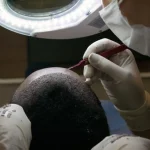 Advantages Of FUE Method In Hair Transplant