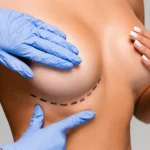Nipple Reconstruction for Inverted Nipples