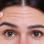 Alın Kırışıklığı için Çözümler