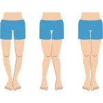 Çarpık Bacak Ameliyatı