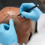 En İyi Saç Ekim Merkezi