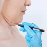 Gıdı Aldırma Ameliyatı