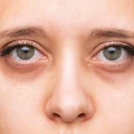 Göz Altı Çukurları Nasıl Giderilir?