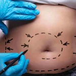 Karın Germe Ameliyatı Olup Pişman Olanlar