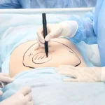 Liposuction Yaptıranlar ve Sonrası