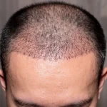 Saç Ekimi Sonrası Süreç İçinde Dikkat Edilmesi Gerekenler